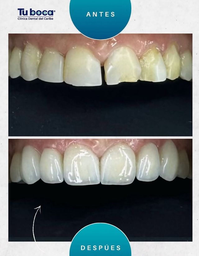 Acercar imagen: Tuboca Clinica Dental Del Caribe