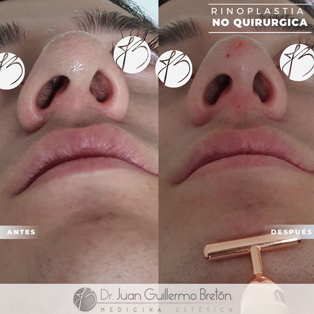 Juan Guillermo Bretón Franco-3