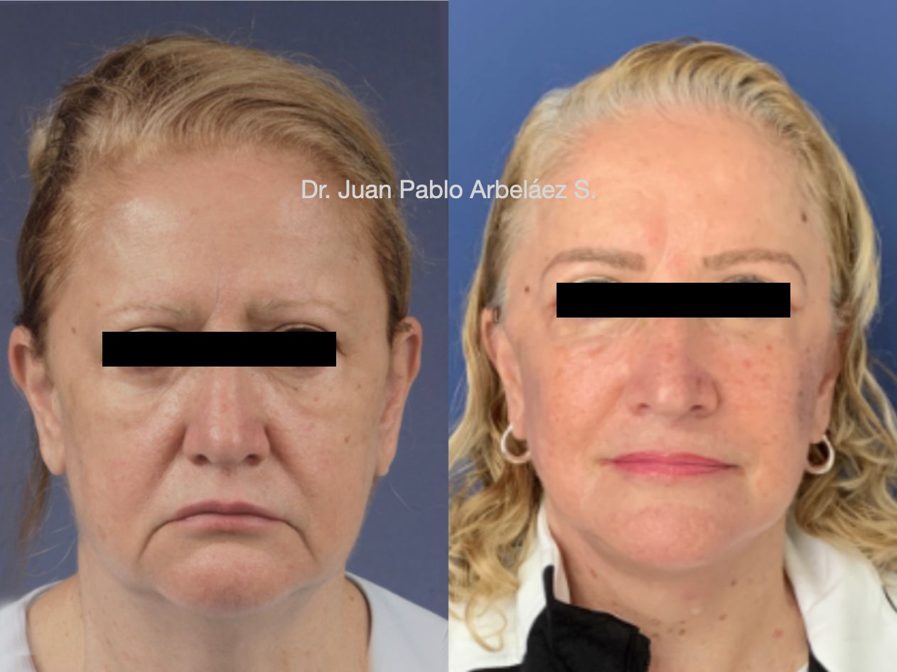 Juan Pablo Arbeláez Sierra-35